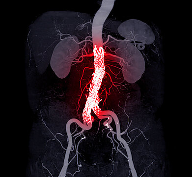 CTA whole aorta with Abdominal aorta stent graft compare 3D rend