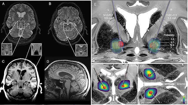 MRT-Scan des Patienten